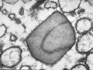 M,62y. | crystalline inclusion in endoplasmic reticulum - bone marrow, plasmocytoma M,62y. | crystalline inclusion in endoplasmic reticulum - bone marrow, plasmocytoma